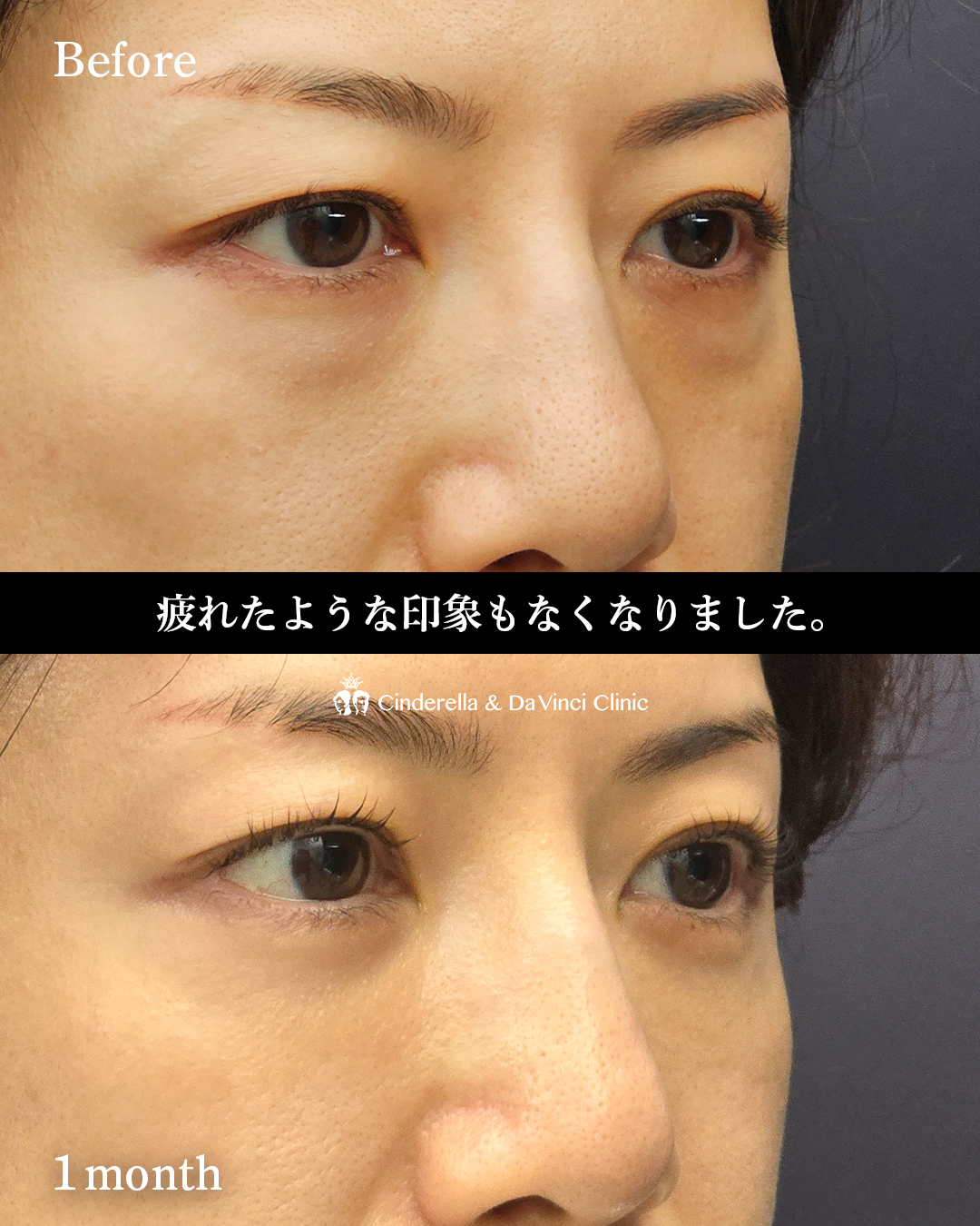 目の下若返りの画像