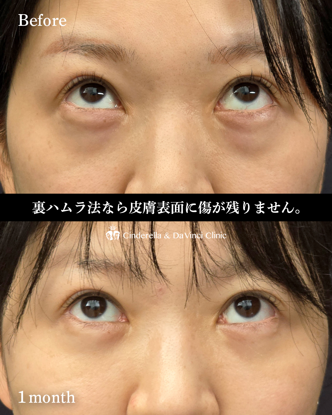 クマ取り(裏ハムラ法)の画像