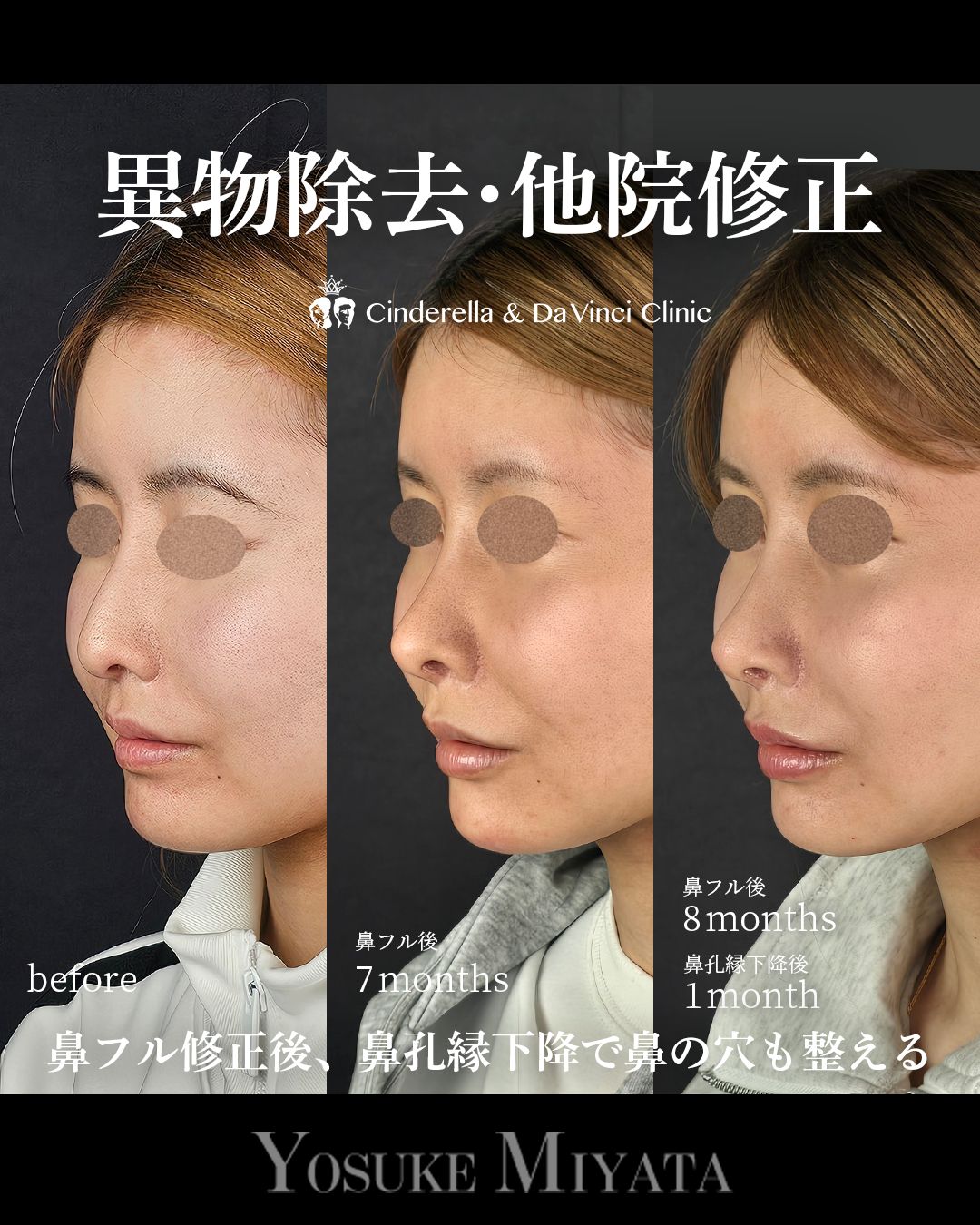 鼻の修正と鼻孔縁下降の画像