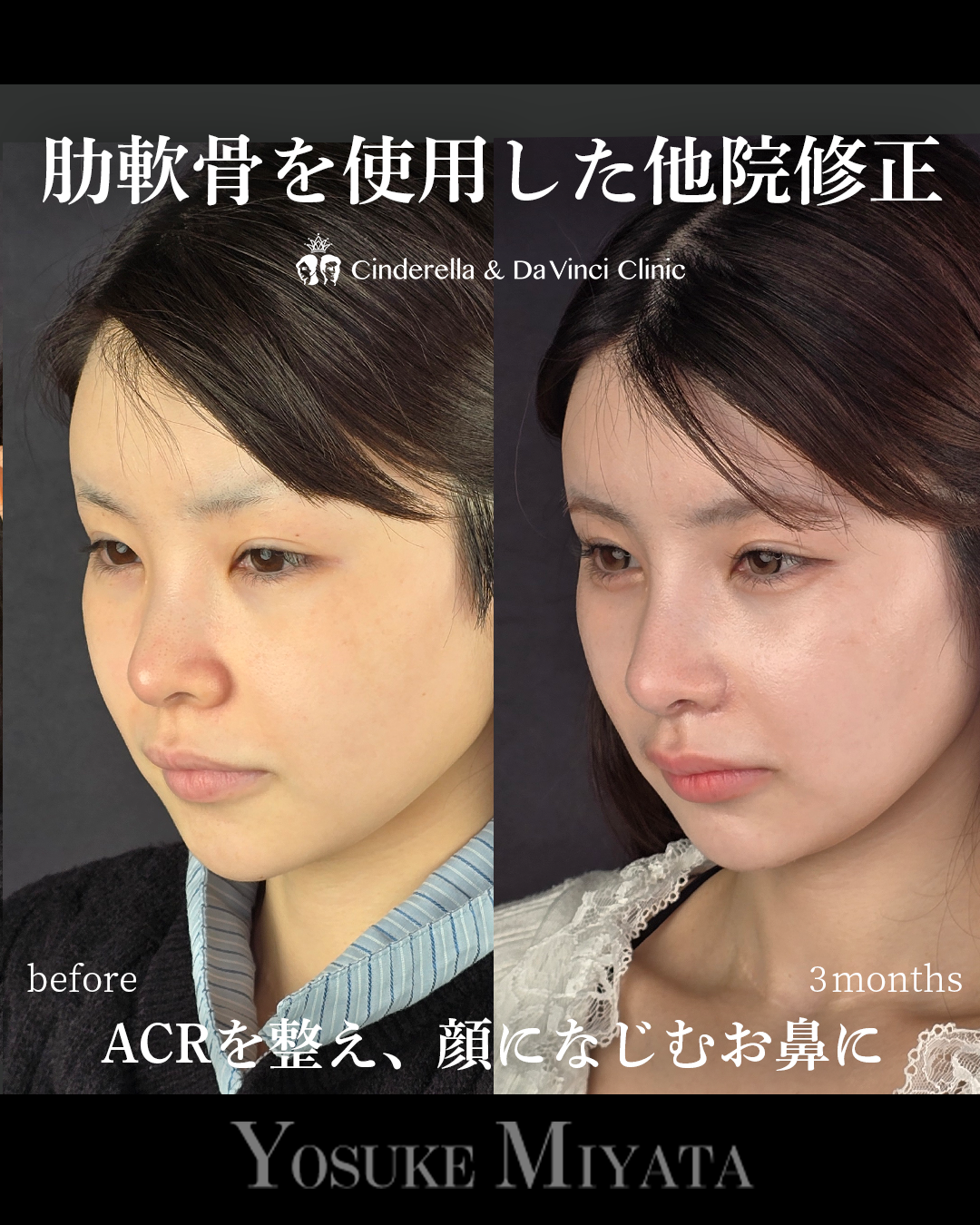 忘れ鼻をつくるの画像