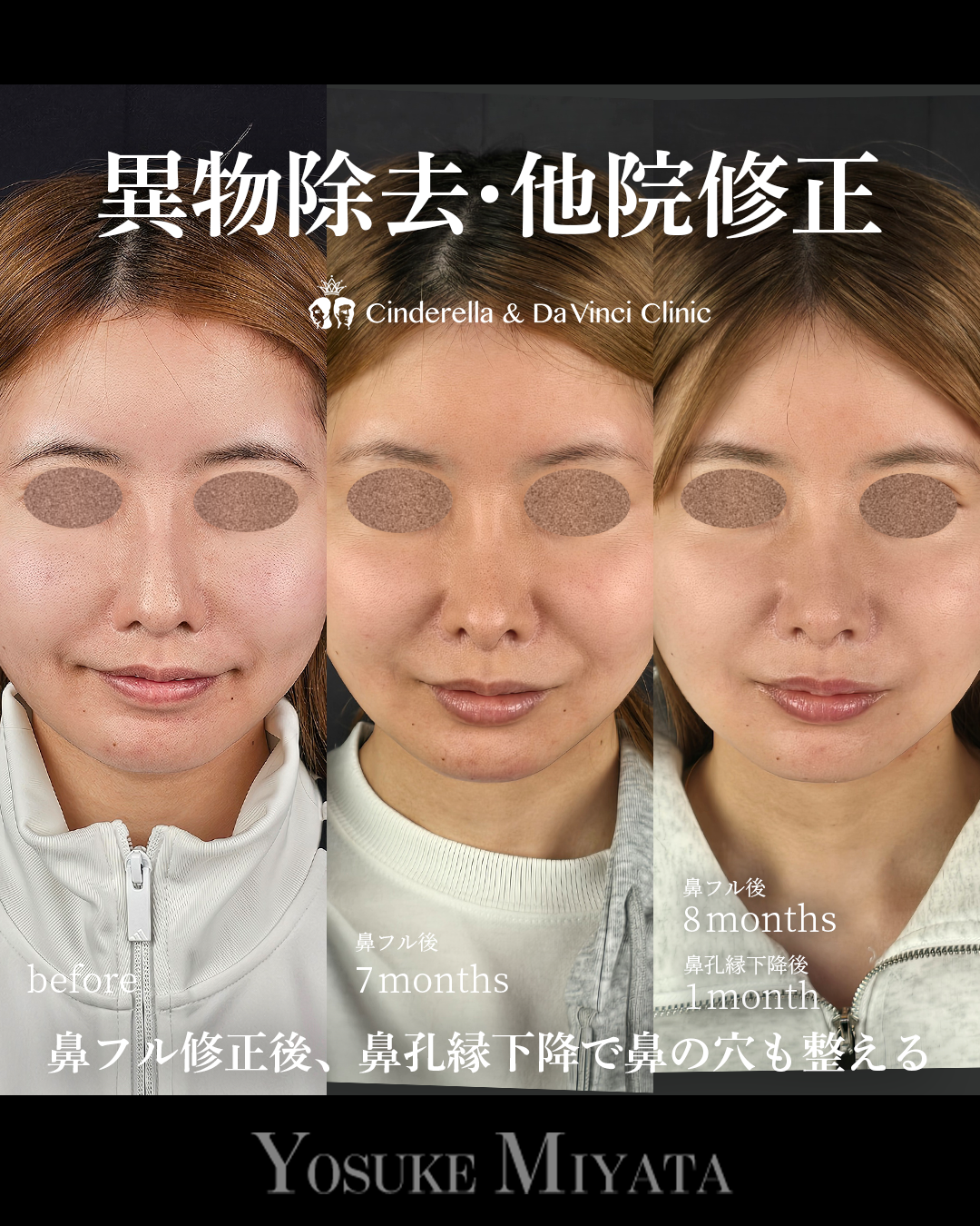 鼻の修正と鼻孔縁下降の画像