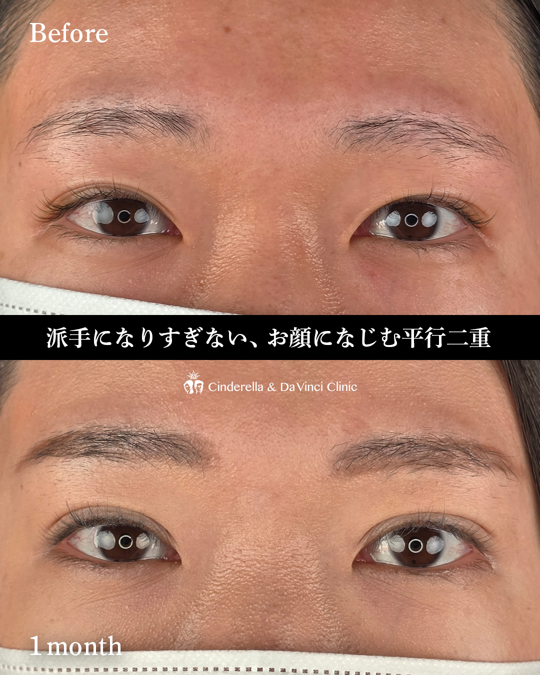 派手すぎない平行二重の画像