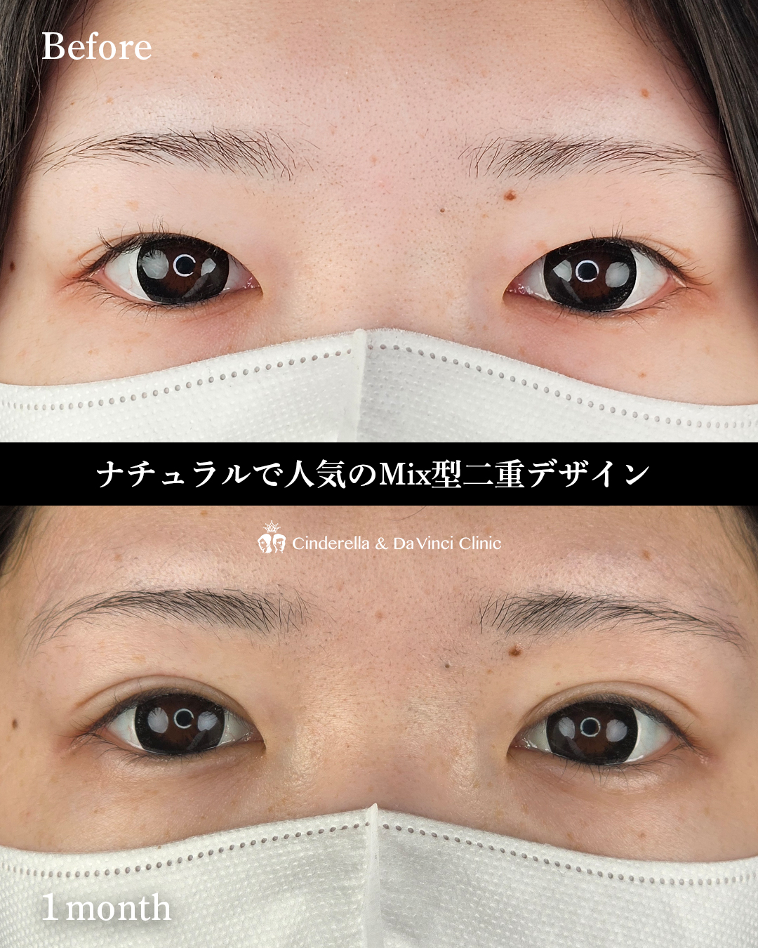 自然癒着法でミックス型二重の画像