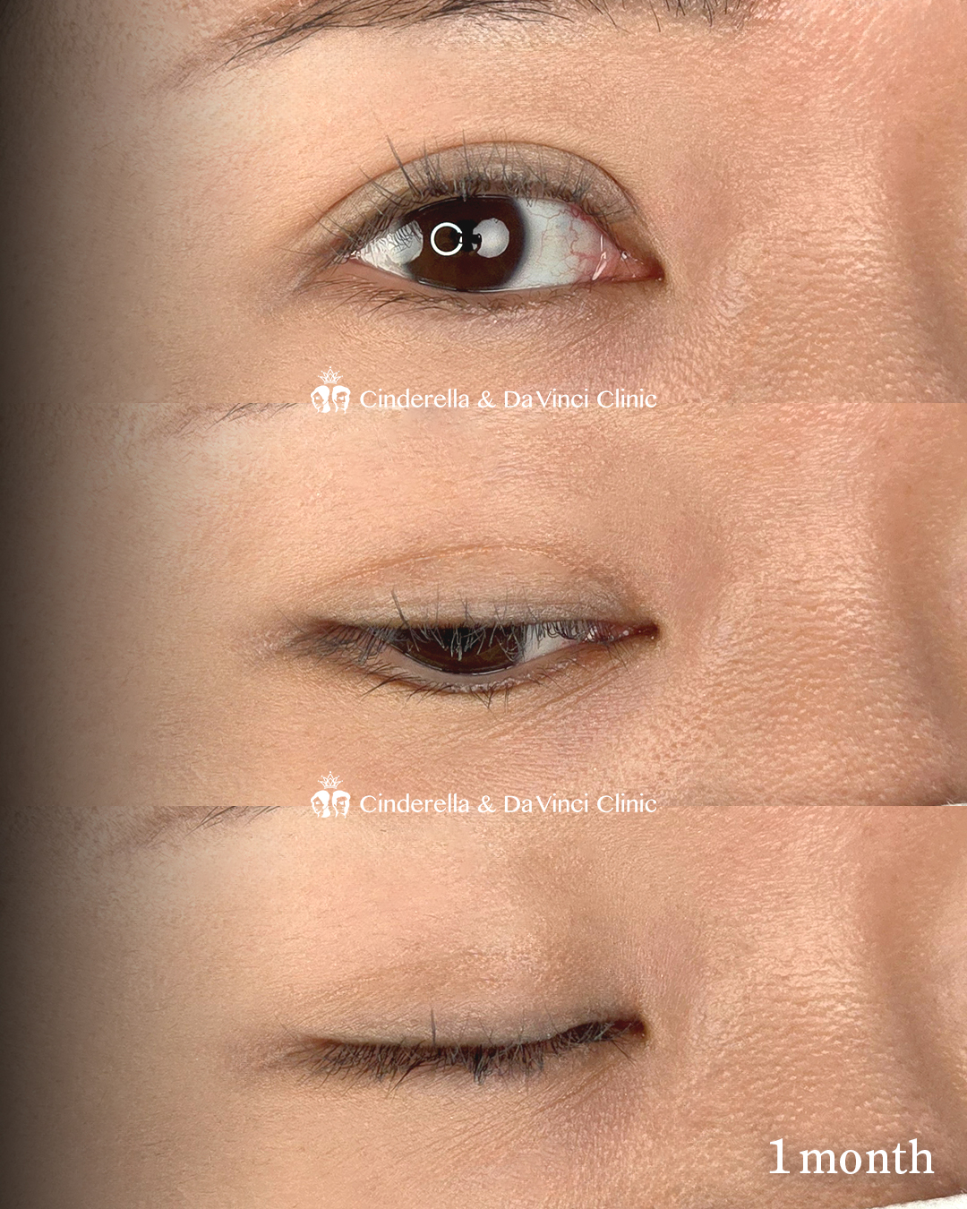 派手すぎない平行二重の画像