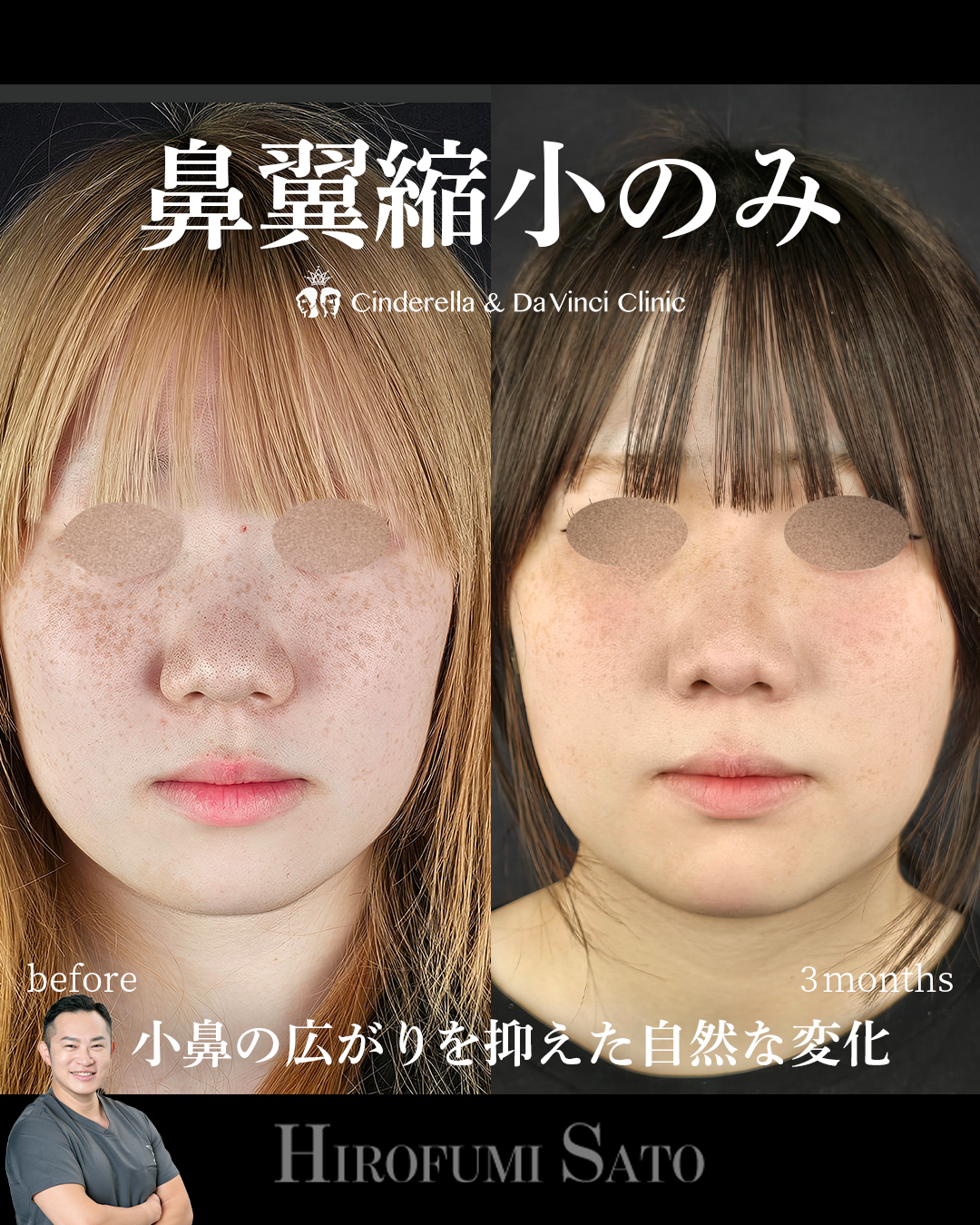 鼻翼縮小のみの画像