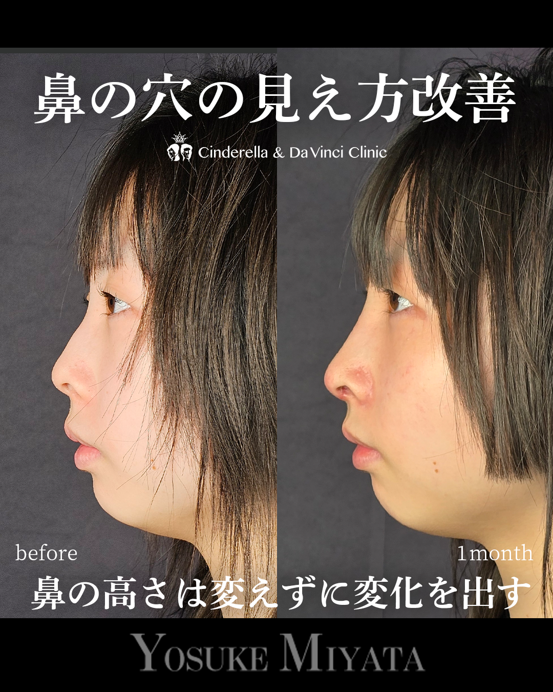 鼻の穴の見え方改善の画像