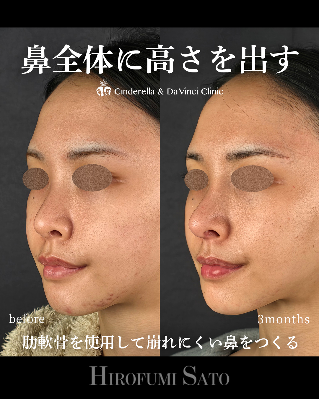 鼻全体に高さを出す