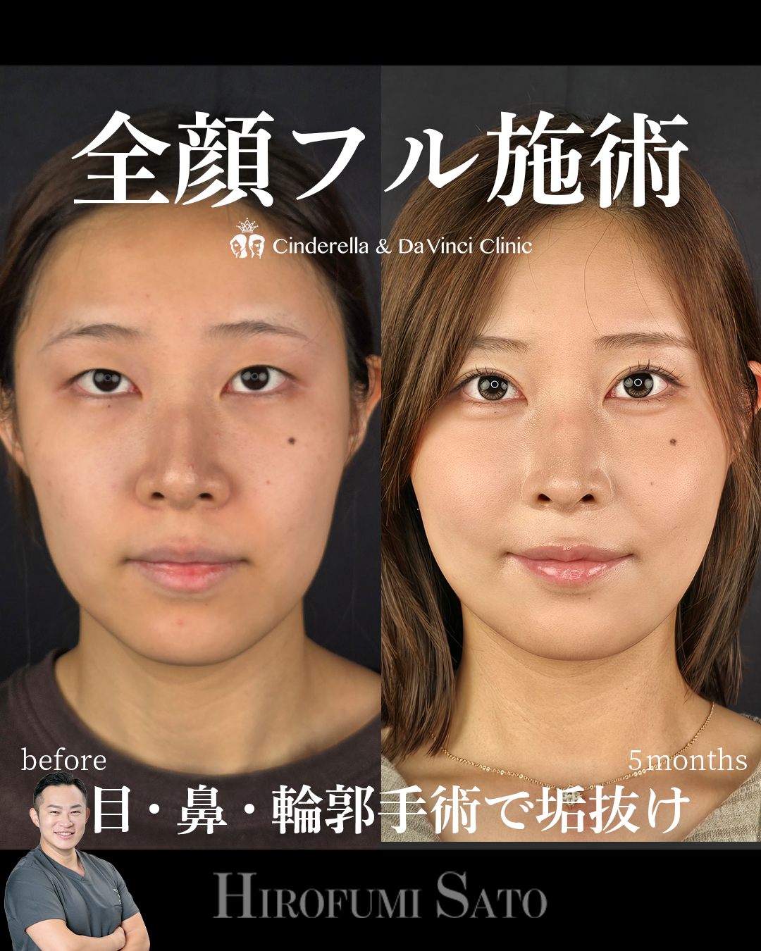 脂肪吸引と鼻整形の画像