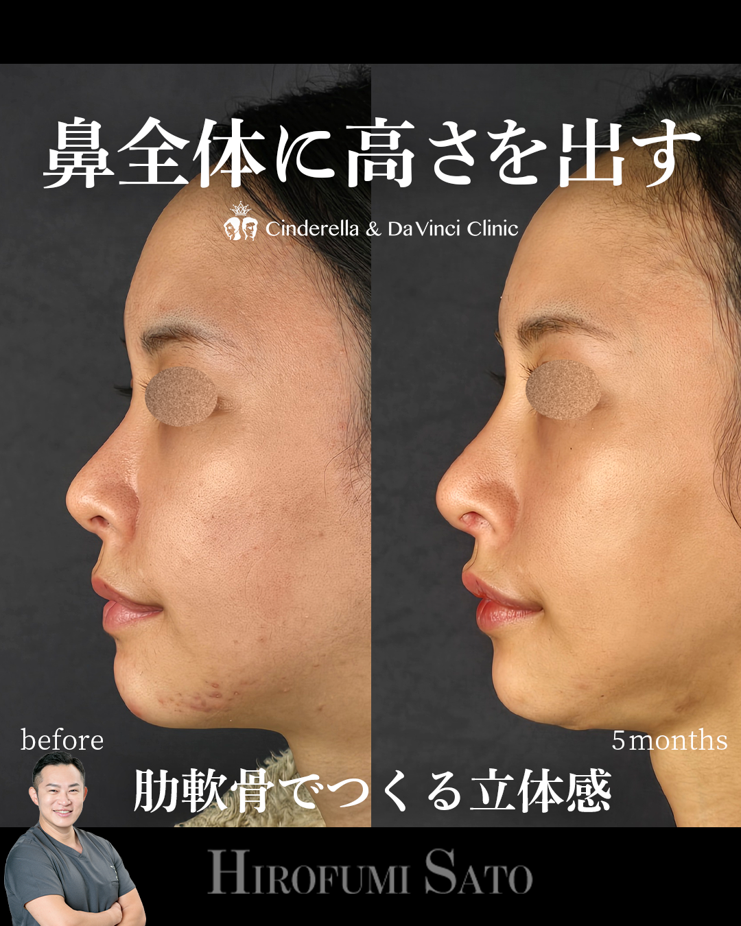 鼻全体に高さを出すの画像