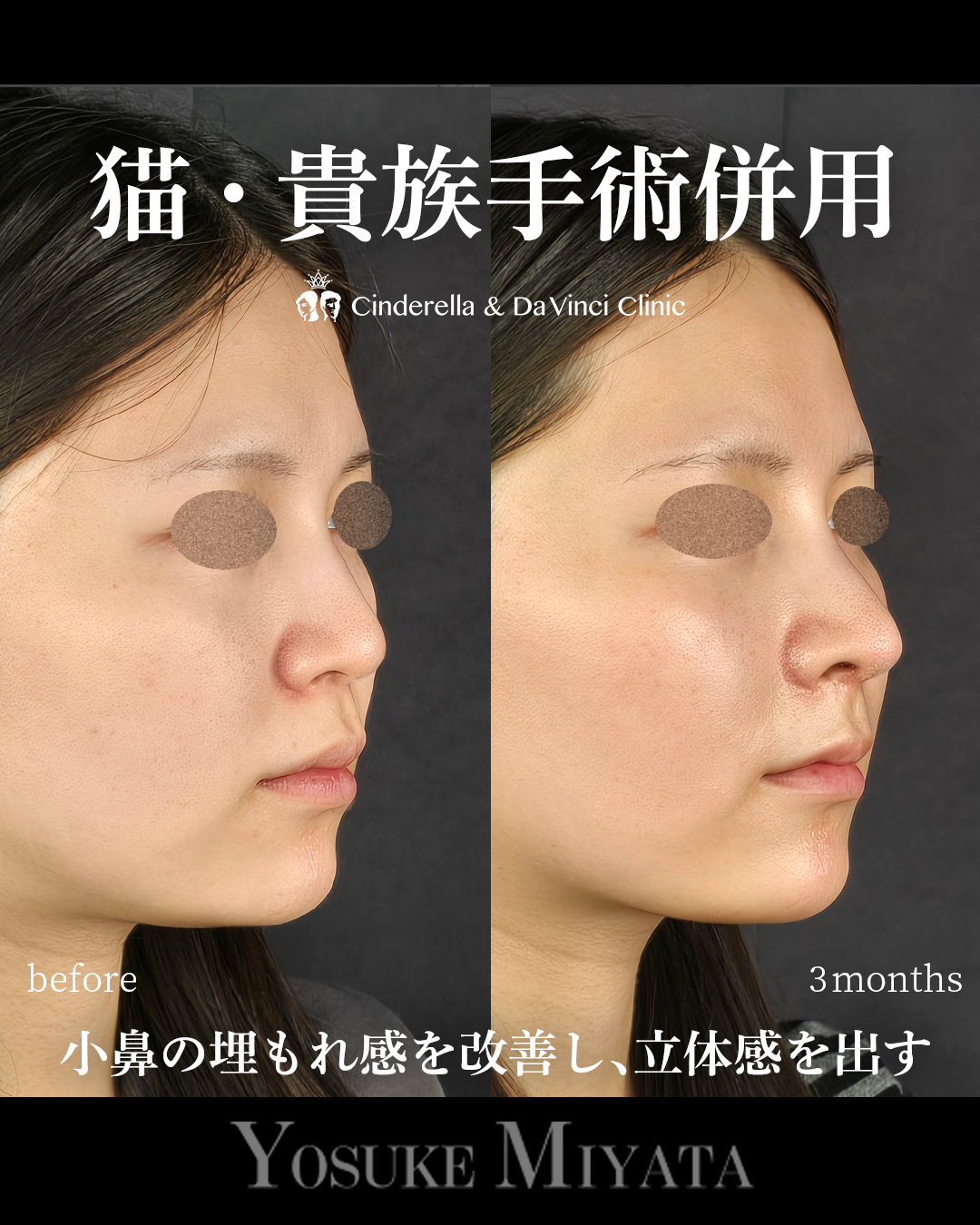 小鼻の埋もれ改善の画像