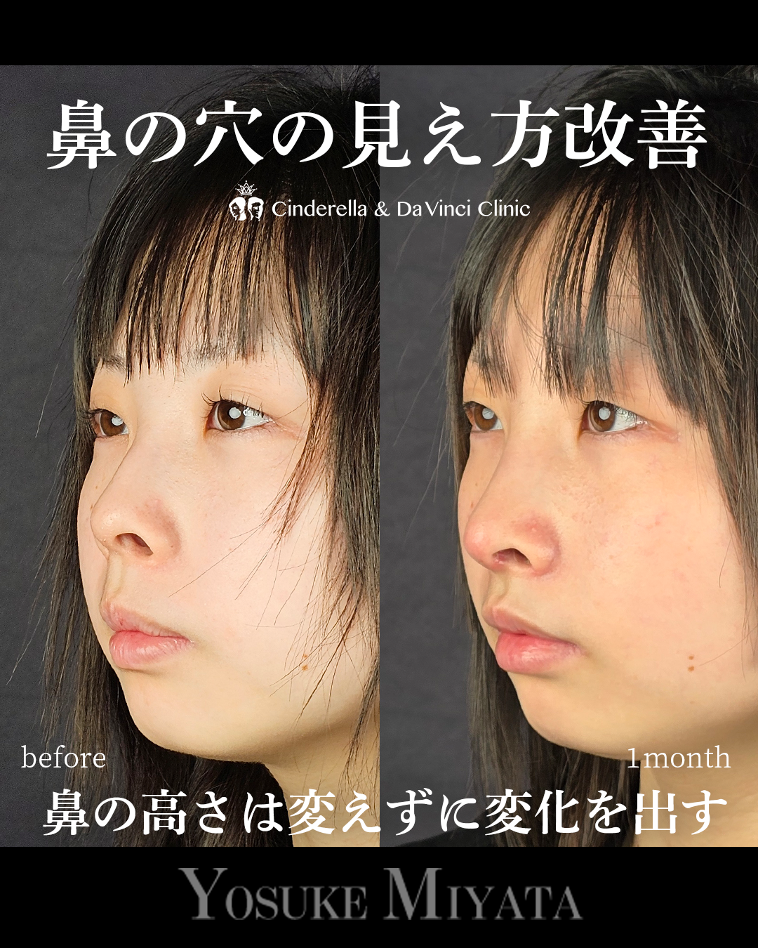 鼻の穴の見え方改善の画像