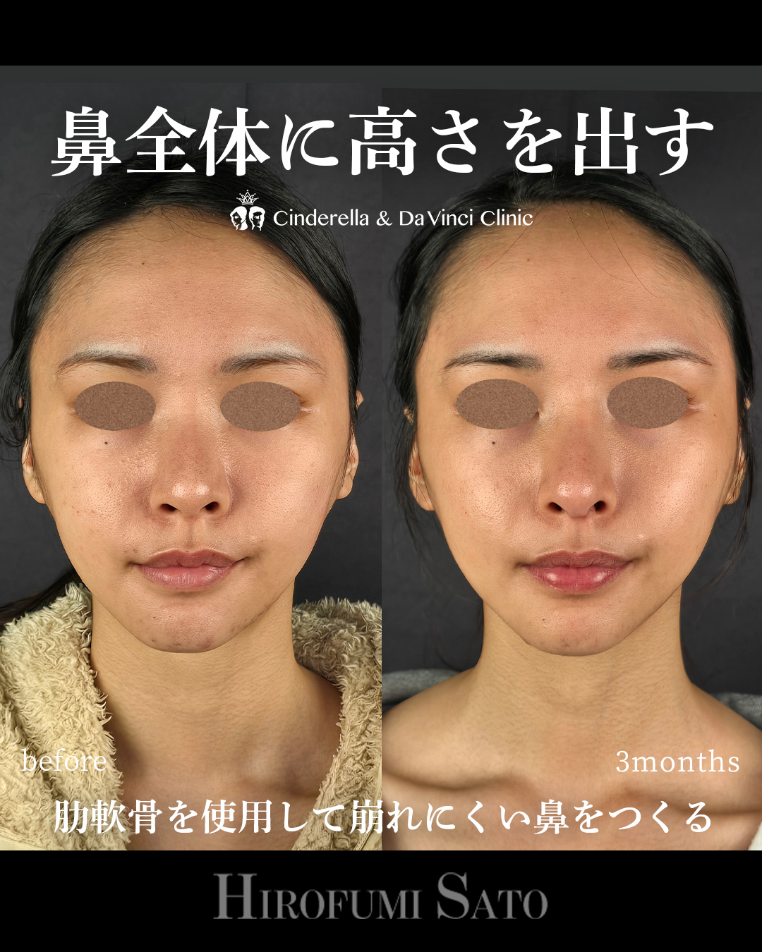 鼻全体に高さを出すの画像