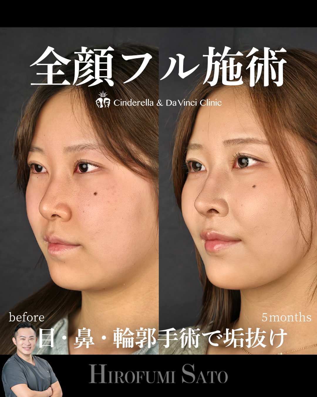 脂肪吸引と鼻整形の画像