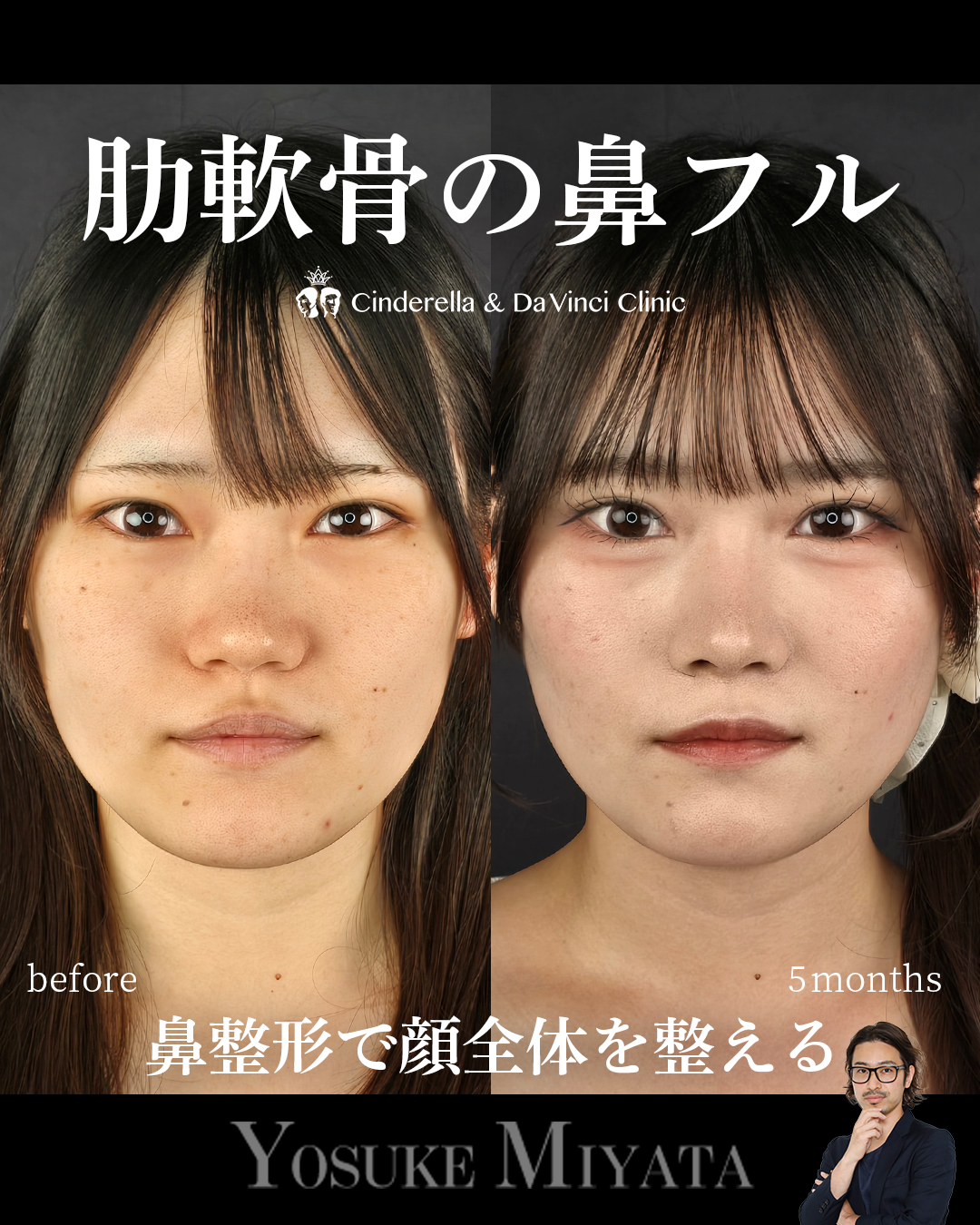 鼻フル×中顔面の画像