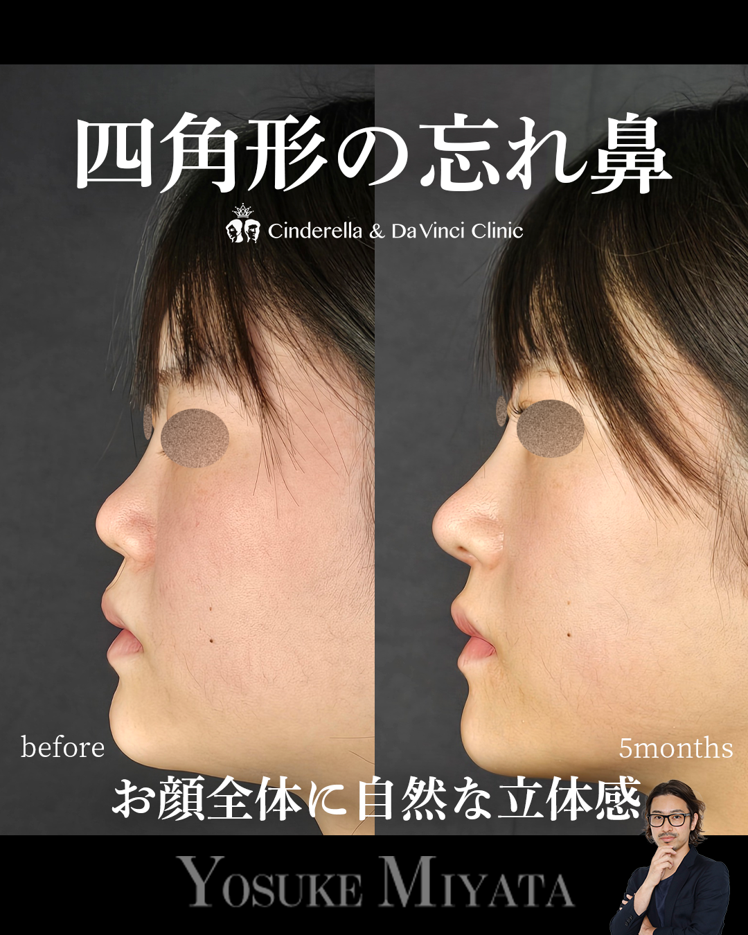 四角形の忘れ鼻の画像