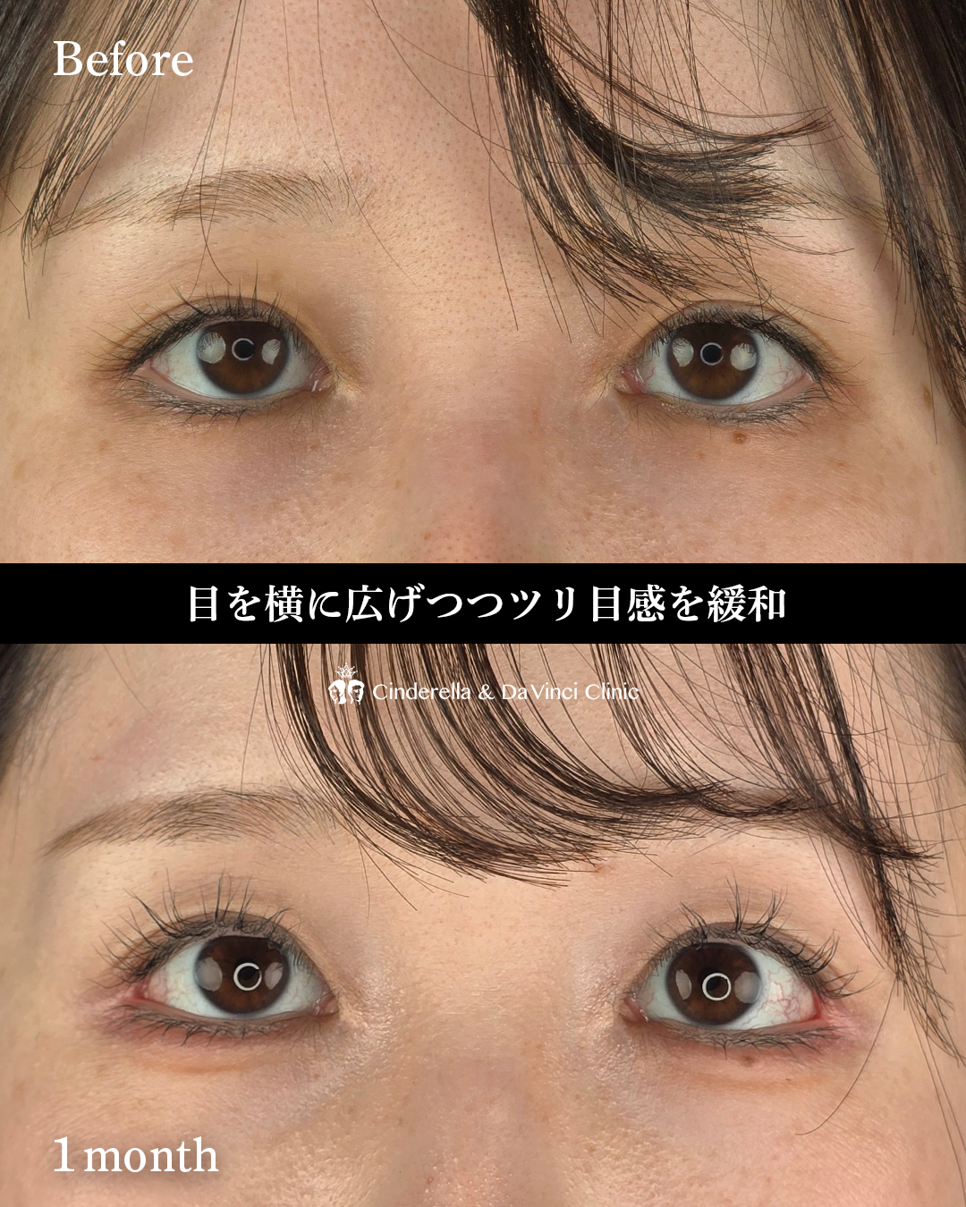 タレ目尻切開の画像