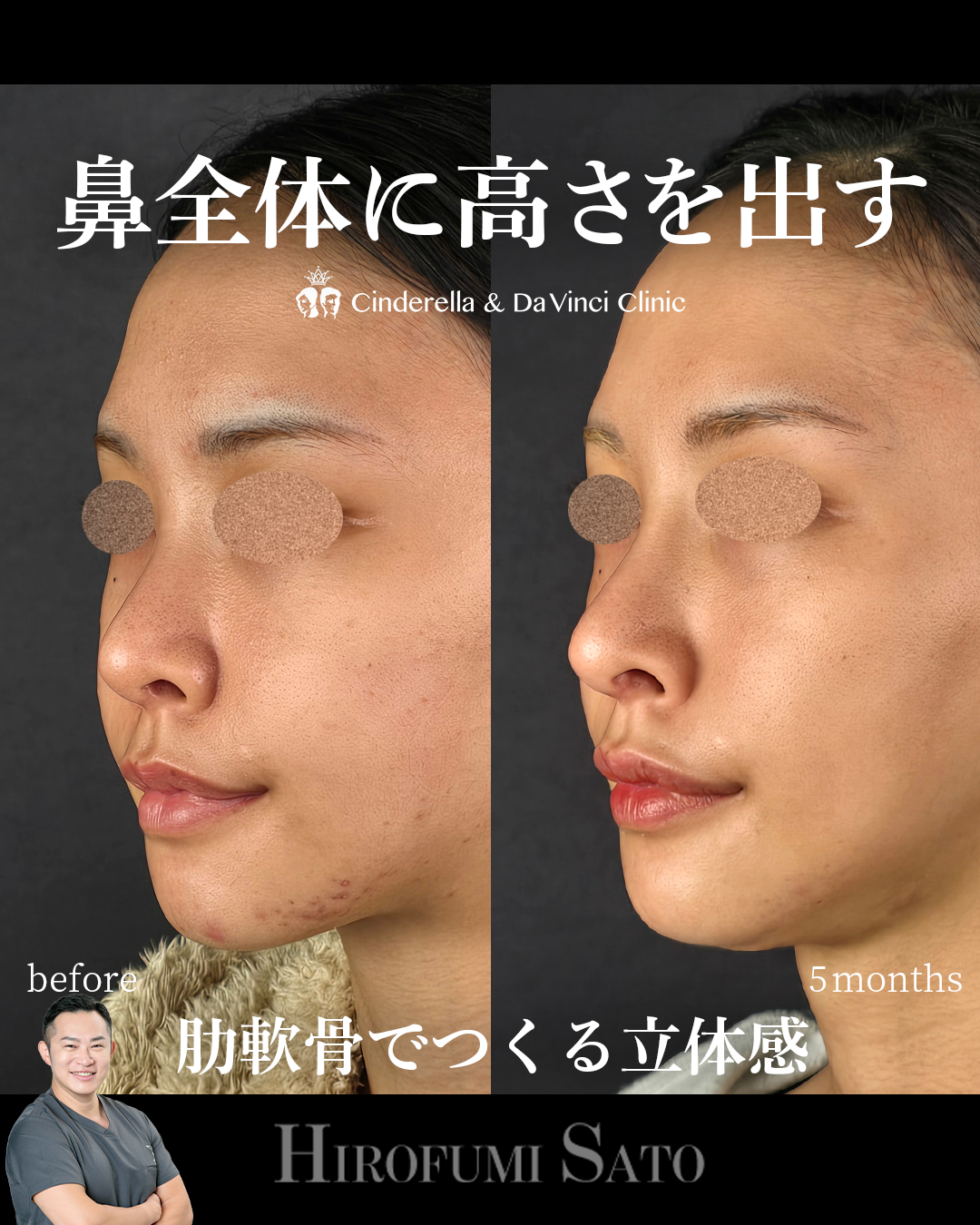 鼻全体に高さを出すの画像