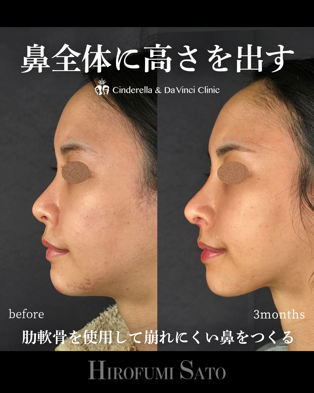鼻全体に高さを出すの画像