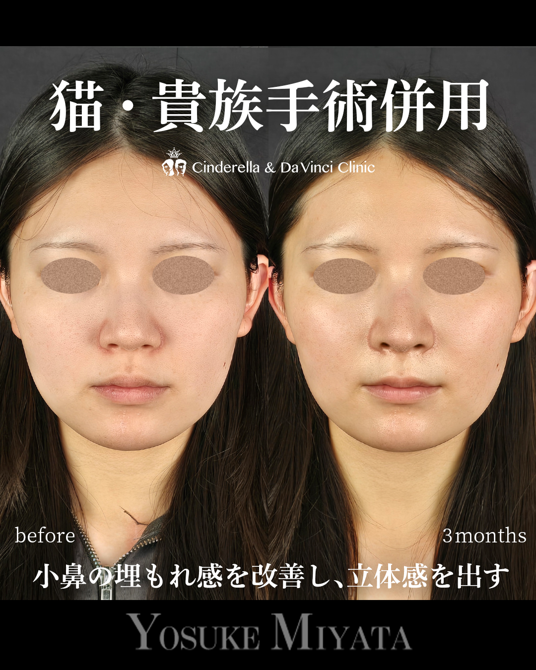 小鼻の埋もれ改善の画像