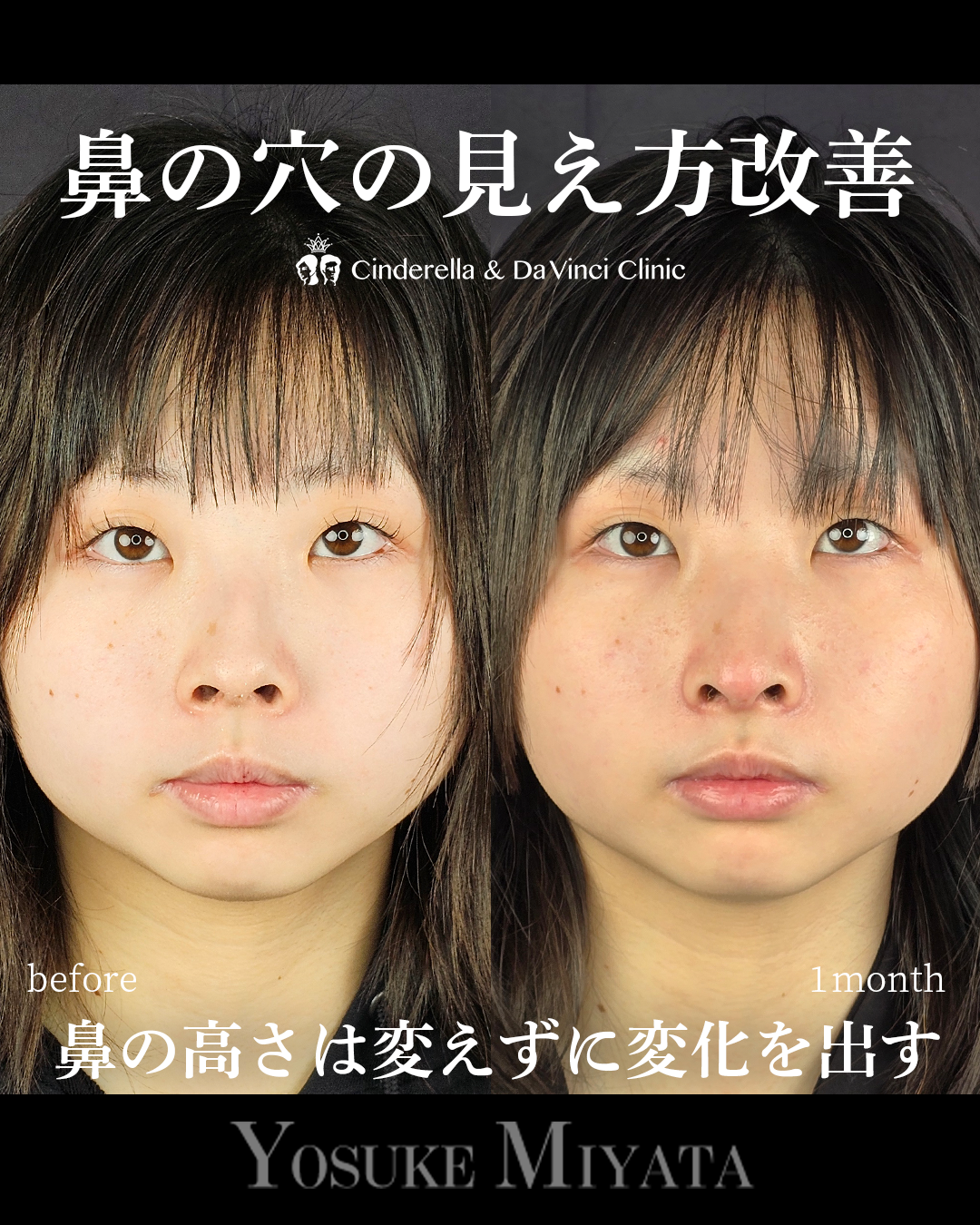 鼻の穴の見え方改善