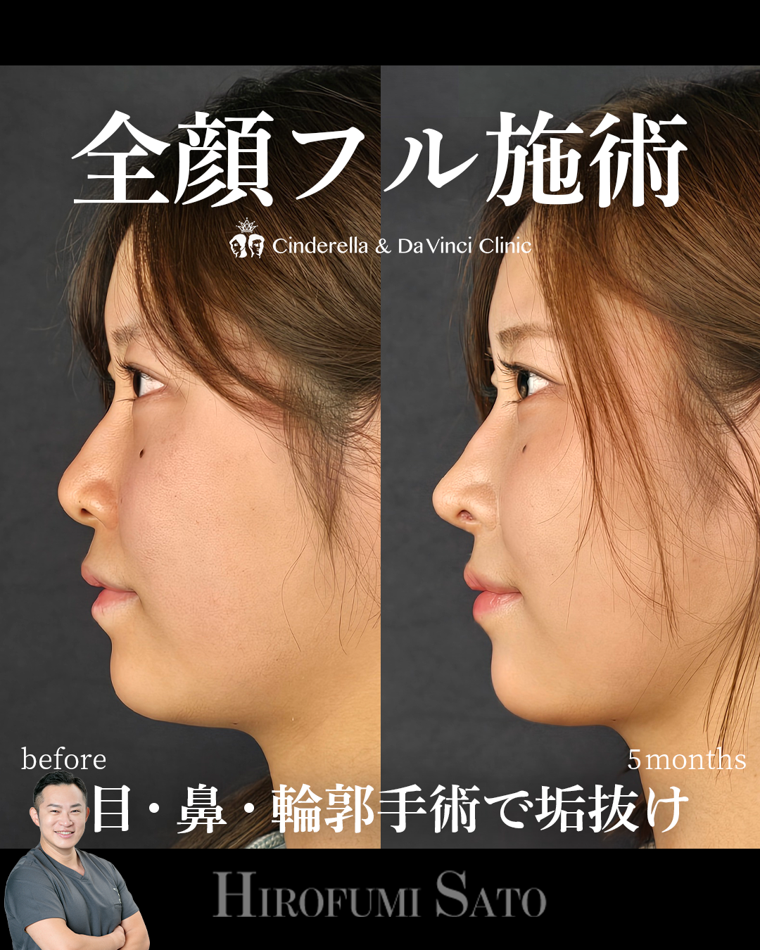 脂肪吸引と鼻整形の画像