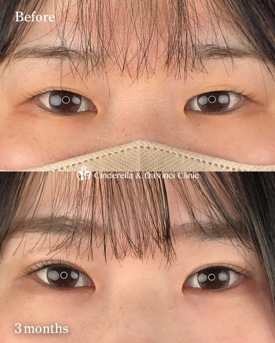 二重切開で末広二重の画像