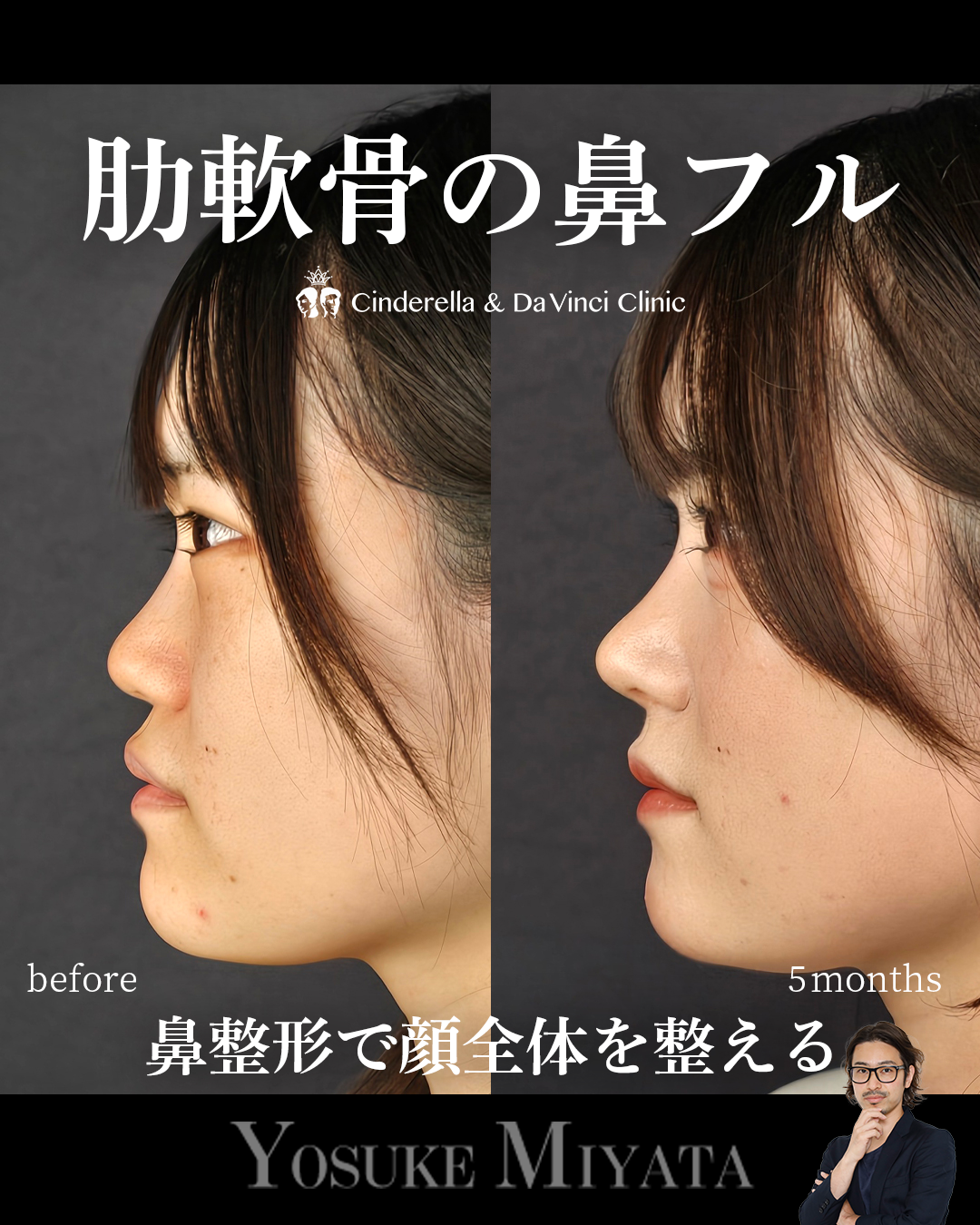 鼻フル×中顔面の画像