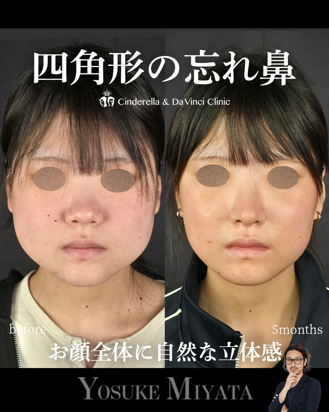 四角形の忘れ鼻の画像