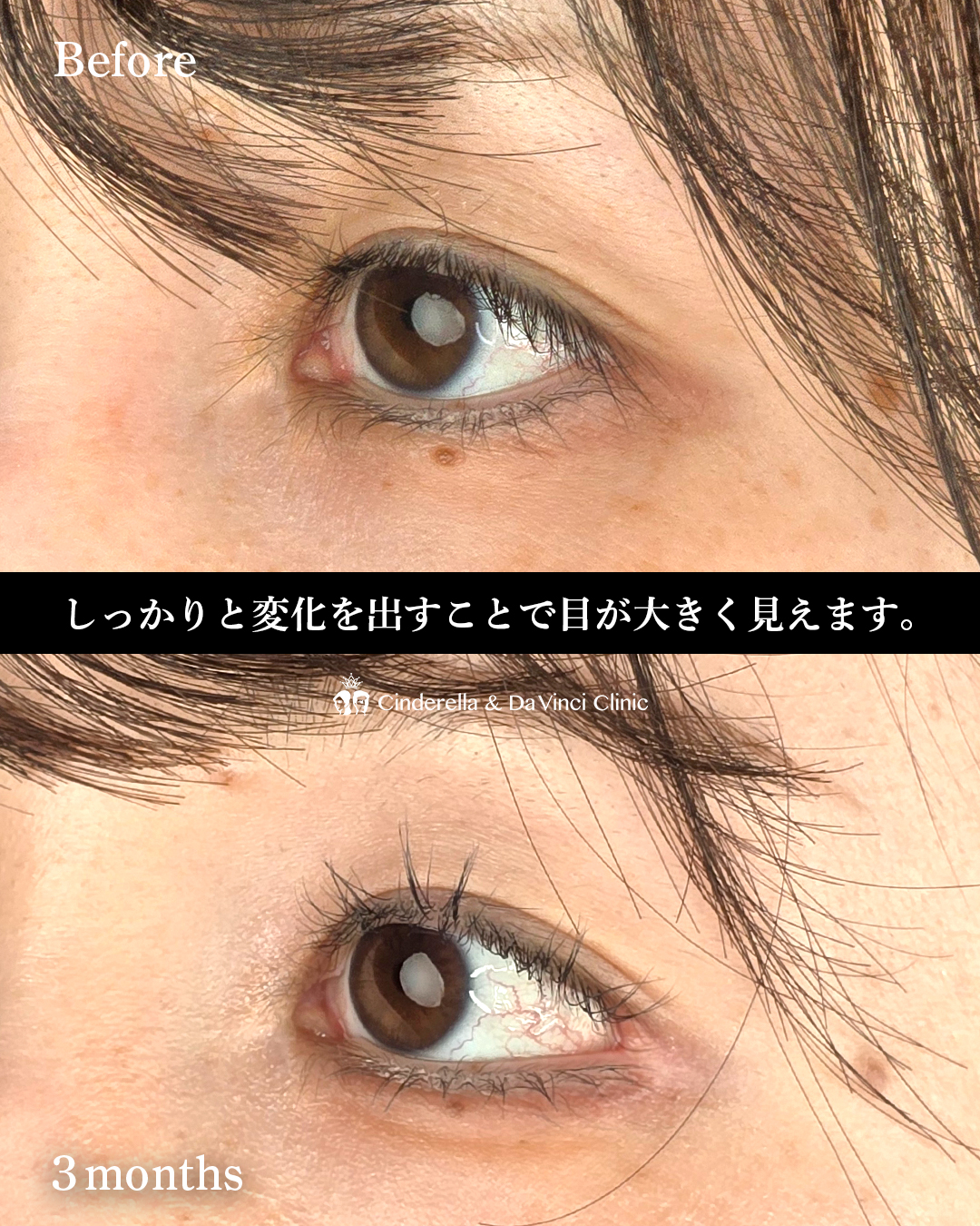 タレ目尻切開の画像