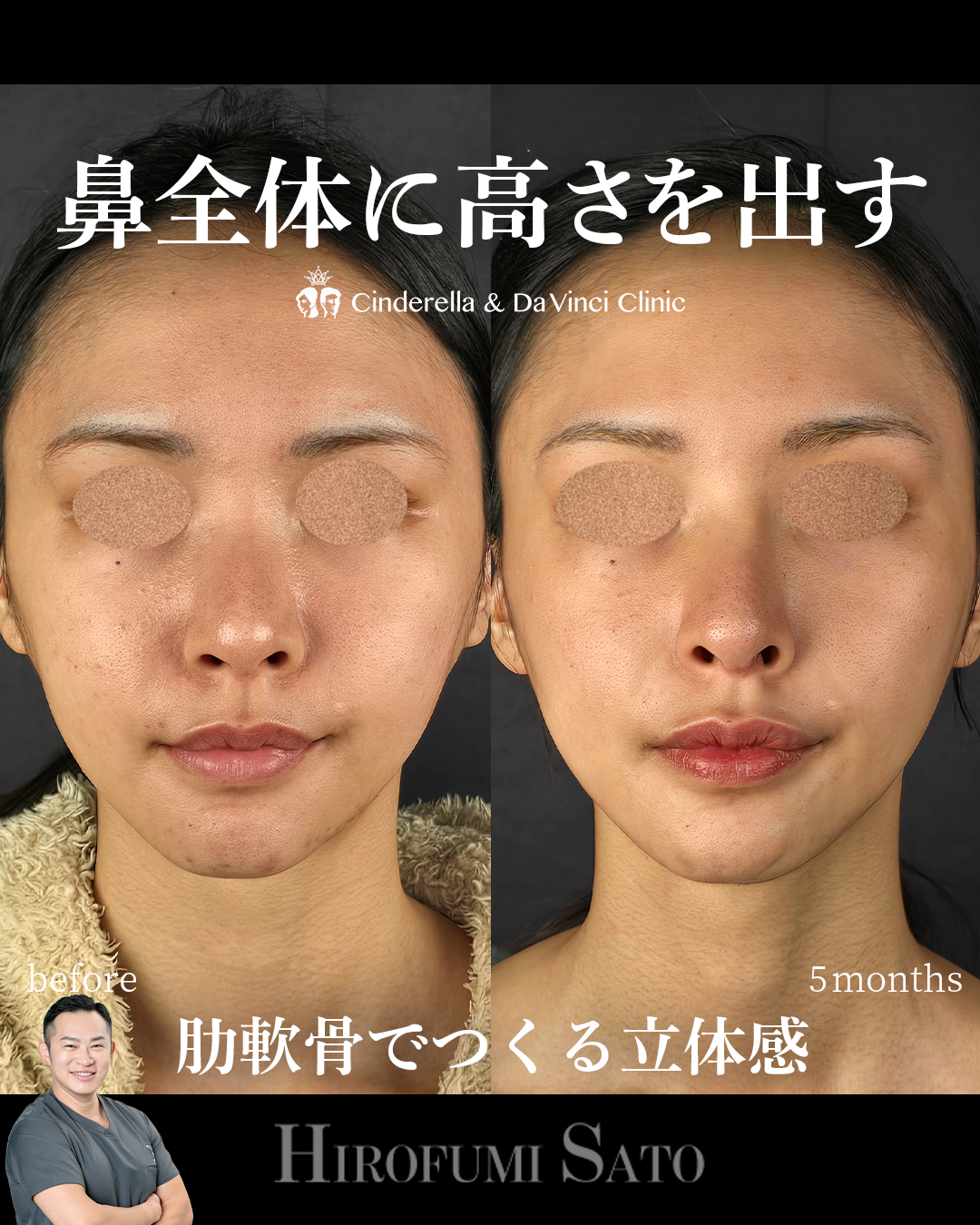 鼻全体に高さを出すの画像