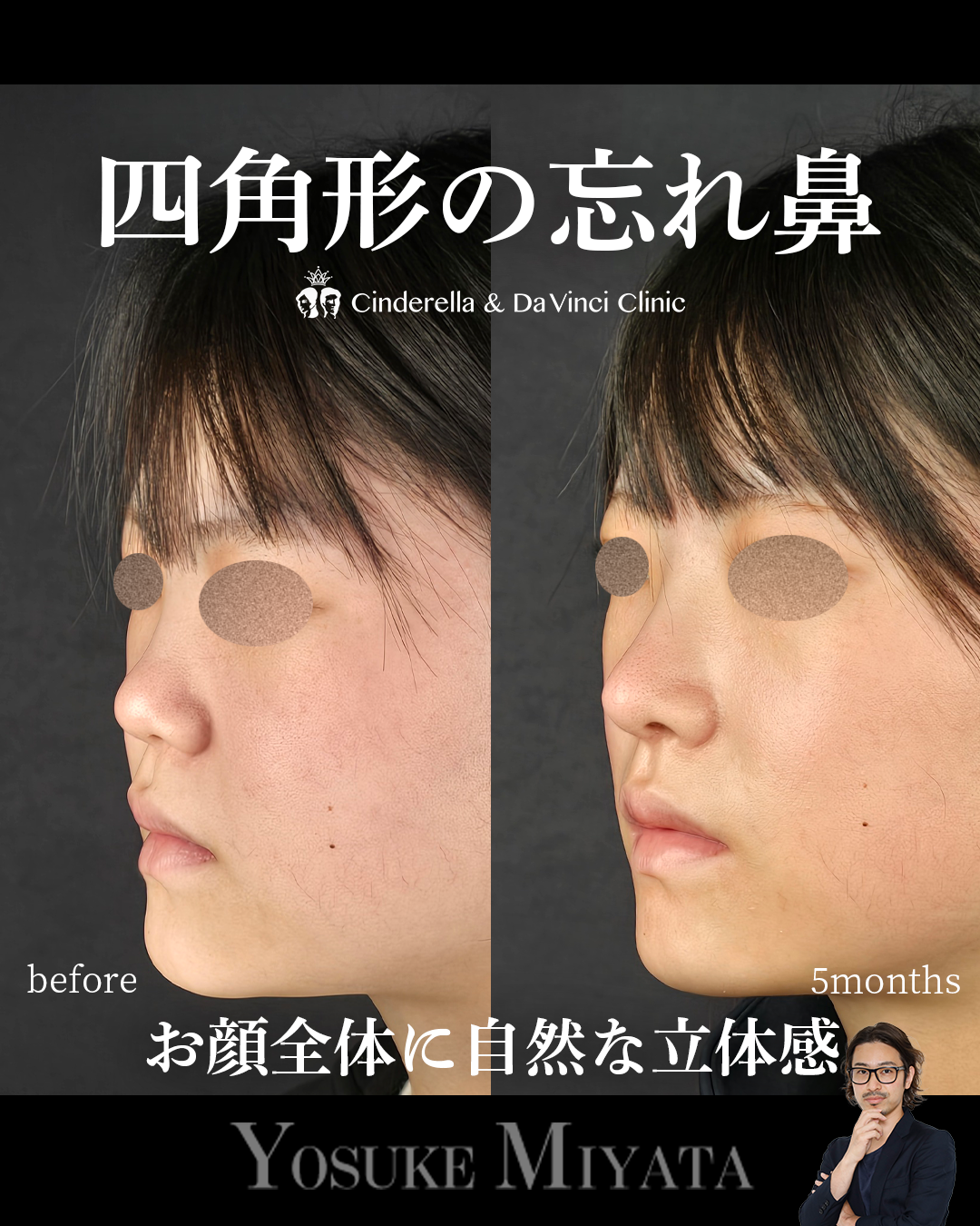 四角形の忘れ鼻の画像