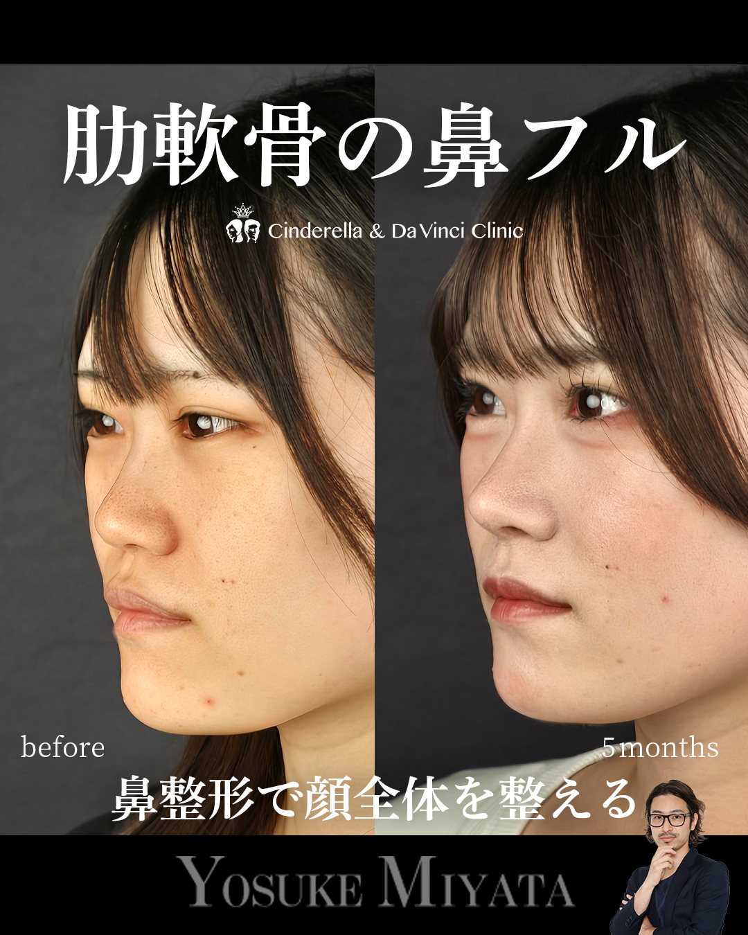 鼻フル×中顔面の画像