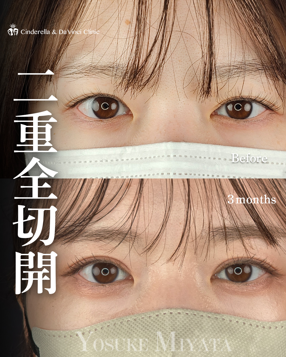 切開で二重をつくるの画像