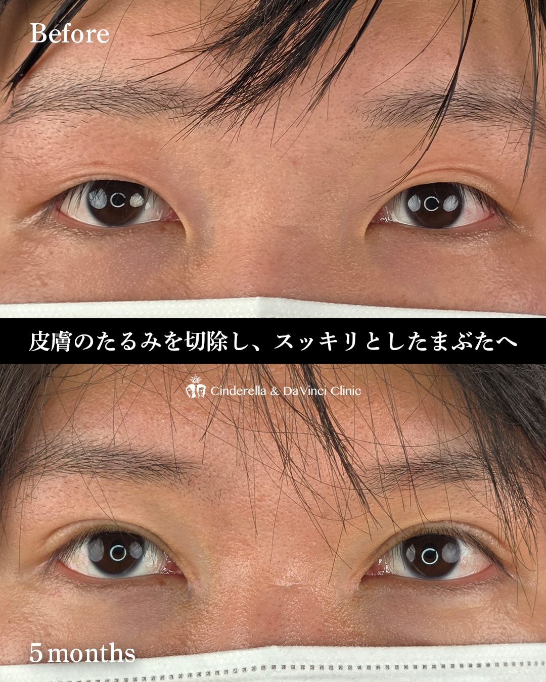 まぶたのたるみを切開で取るの画像
