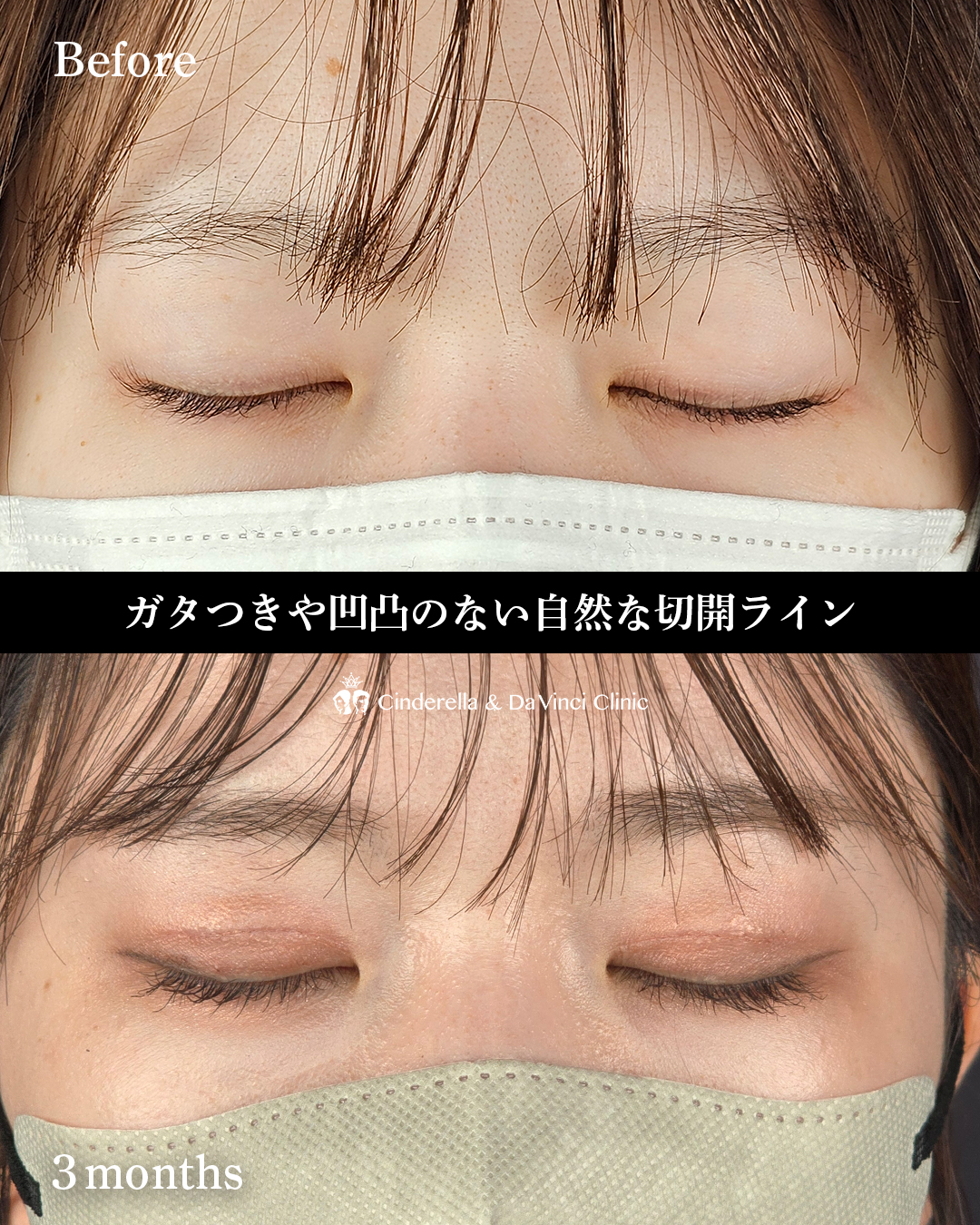切開で二重をつくるの画像