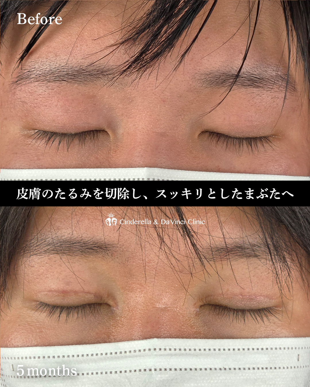 まぶたのたるみを切開で取るの画像