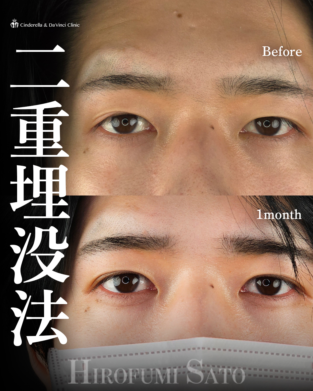 男性の二重埋没