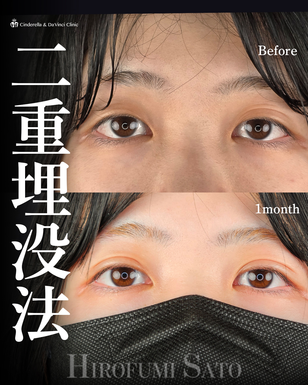 自然癒着法で二重に