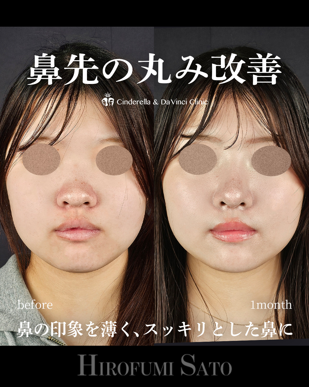 鼻先の丸み改善