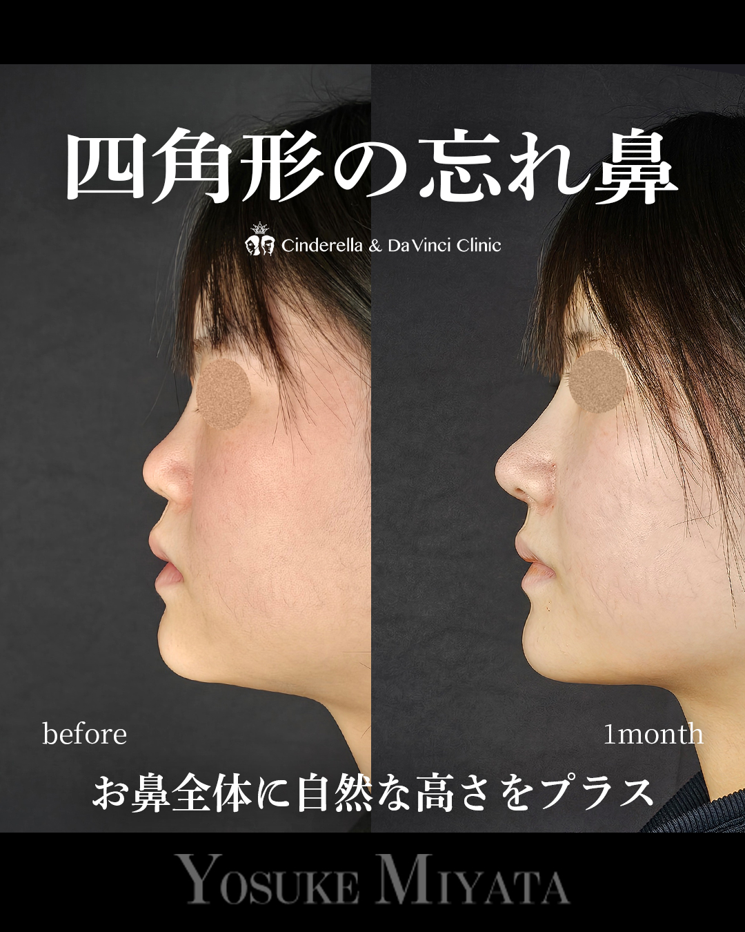 四角形の忘れ鼻