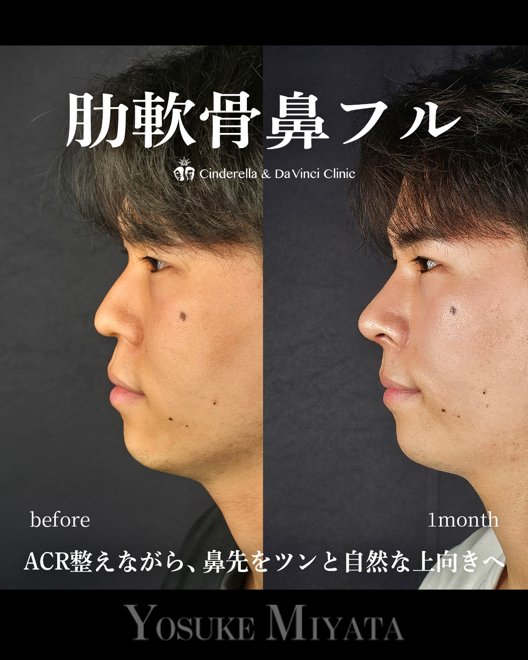 肋軟骨鼻フル