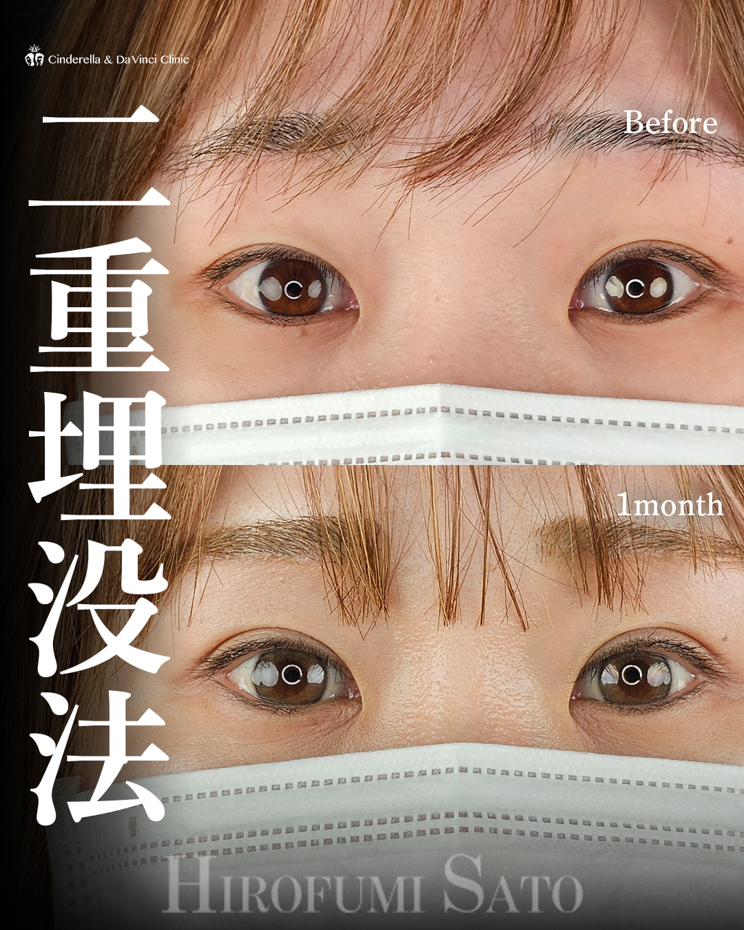 埋没で明るいお目元に