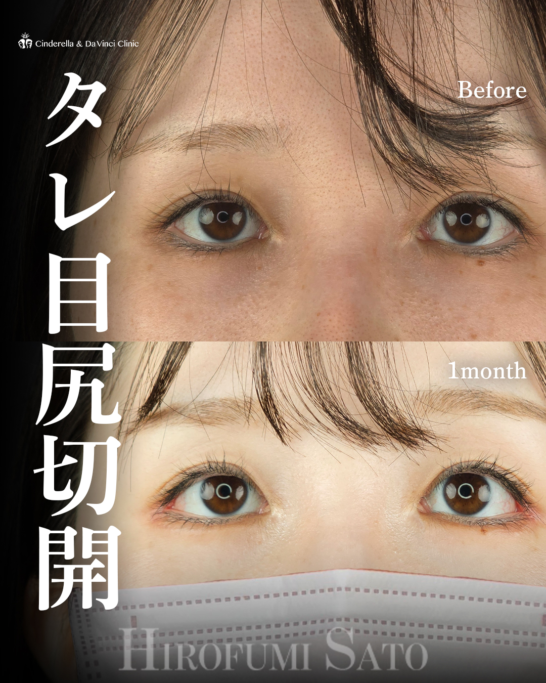 タレ目尻切開