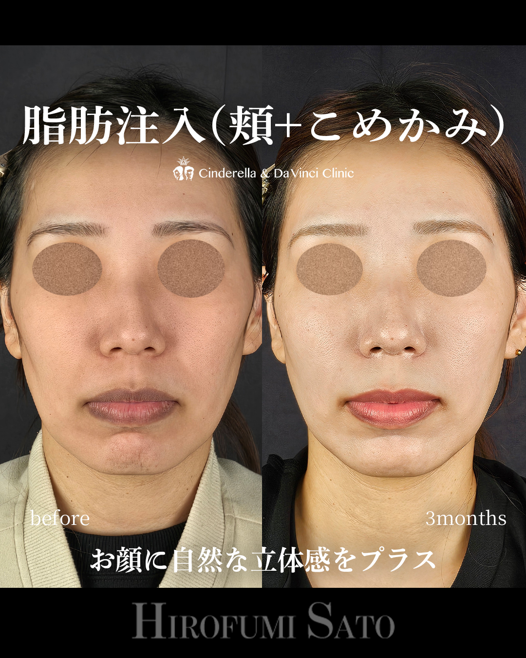 頬コケの脂肪注入の画像