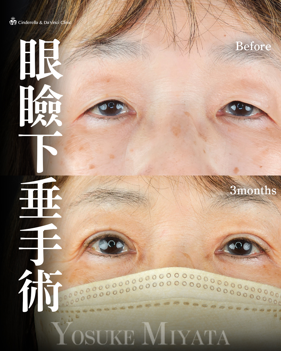 目の開き改善