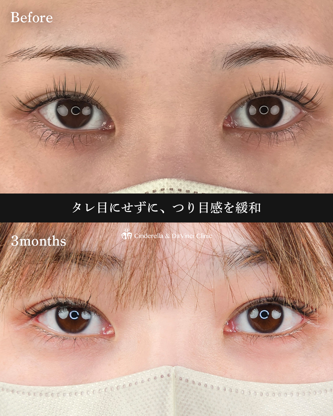 タレ目と目尻切開の画像