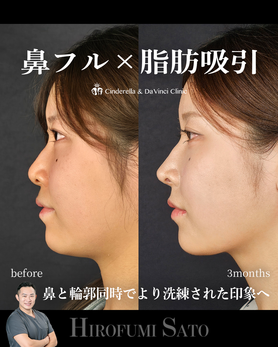 脂肪吸引と鼻整形の画像