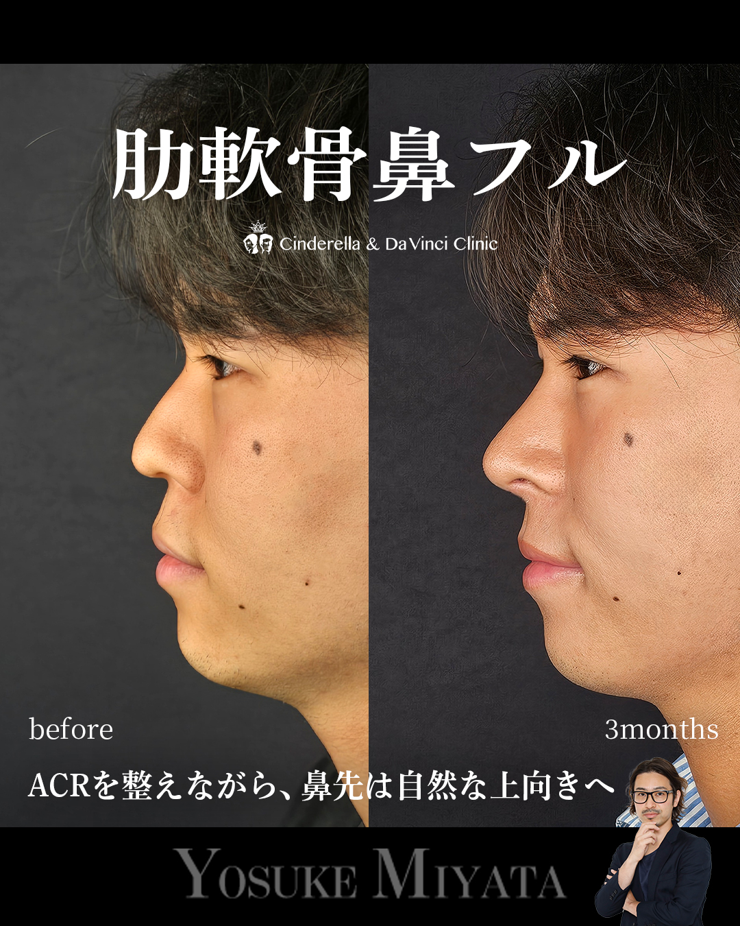 肋軟骨鼻フルの画像