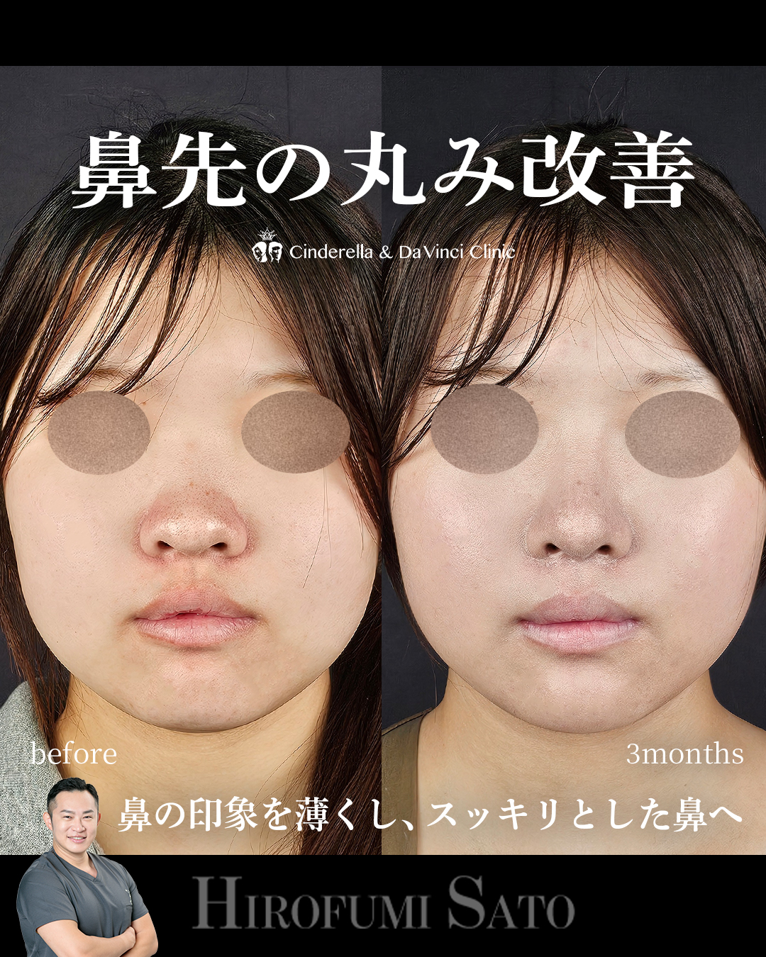 鼻先の丸み改善の画像