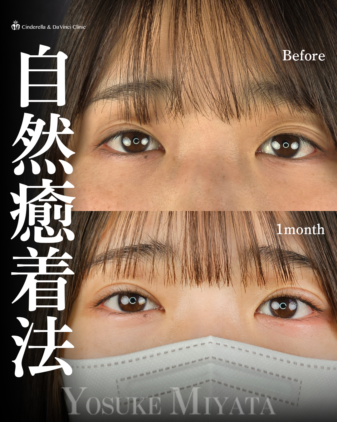 他院埋没の修正
